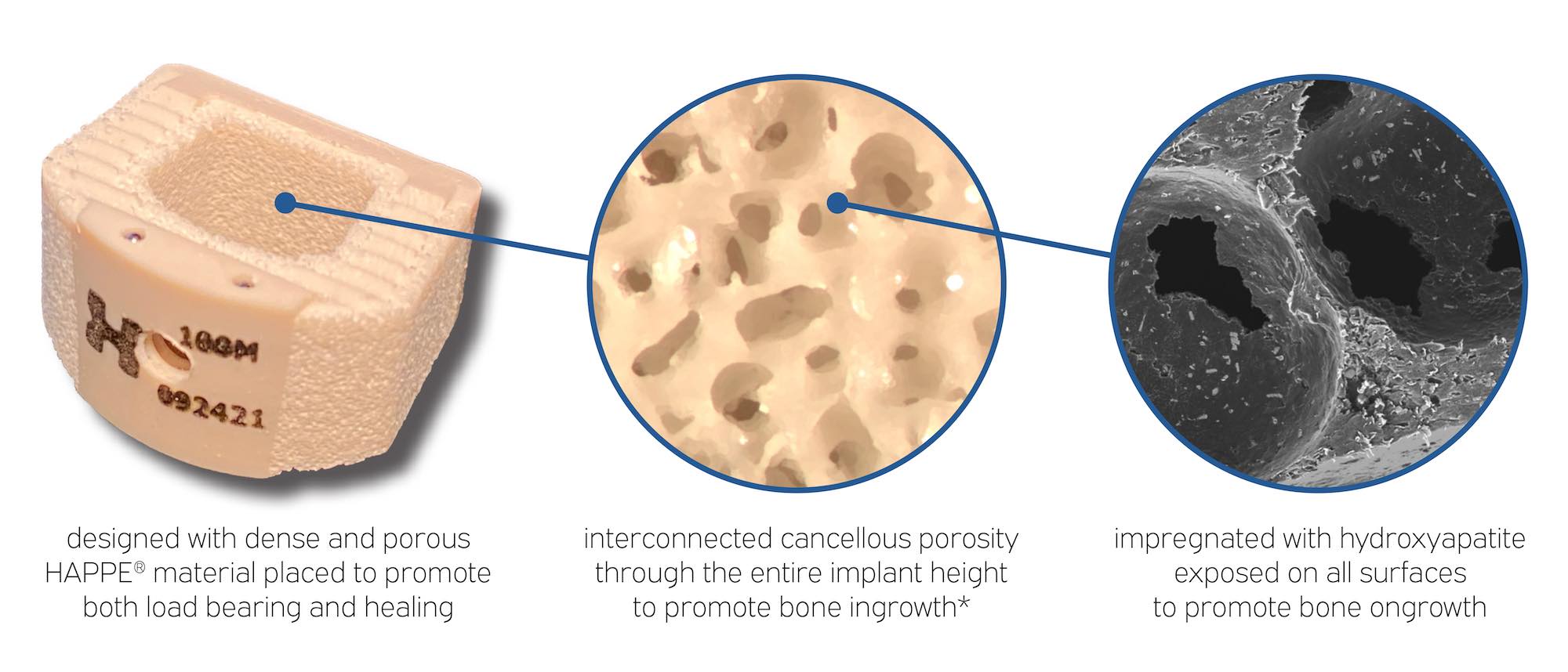 The benefits of HAPPE technology include dense and porous material placed to promote both load bearing and healing. Interconnected cancellous porosity through the entire implant height to promote bone ingrowth. Impregnated with hydroxyapatite exposed on all surfaces to promote bone ongrowth.