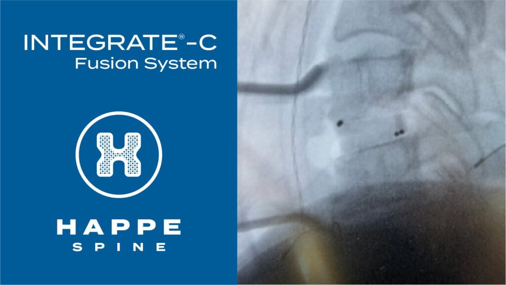 HAPPE Spine First Surgery