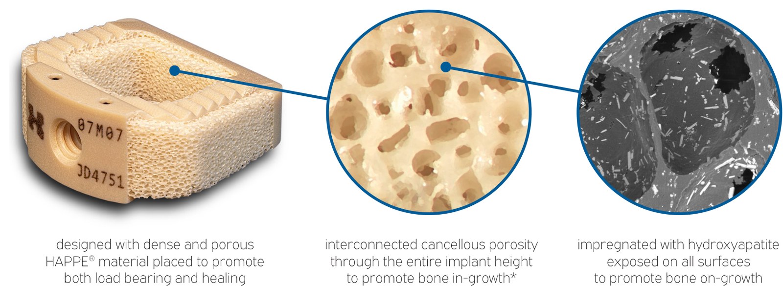 INTEGRATE-C implant with dense and porous HAPPE material, interconnected cancellous porosity, and hydroxyapatite exposed on all surfaces