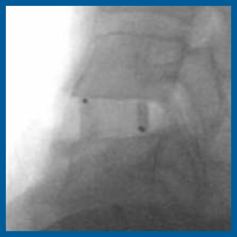 Radiograph showing the radiolucent INTEGRATE-C implant with radiopaque tantalum markers